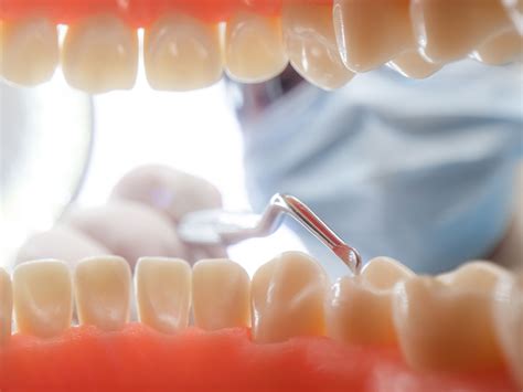 broken tooth west kelowna|Dental Crowns & Bridges .